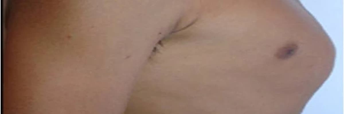 Pektus Cariantum (Güvercin göğsü) nedir ve tedavisi nelerdir?