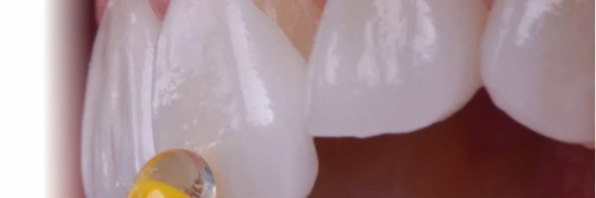 Laminate veneer (Yaprak porselen) nedir ve nasıl uygulanır?