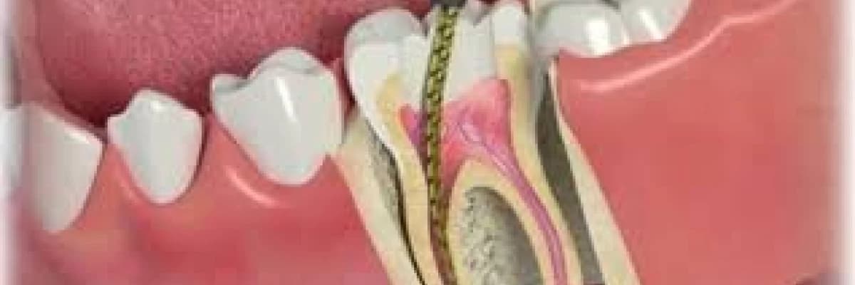 Kanal Tedavisi (Endodonti) Nedir, Nasıl Yapılır?