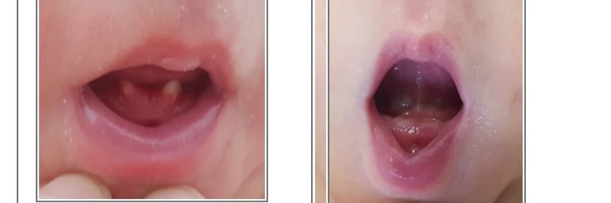 Yenidoğan Bebekte Diş