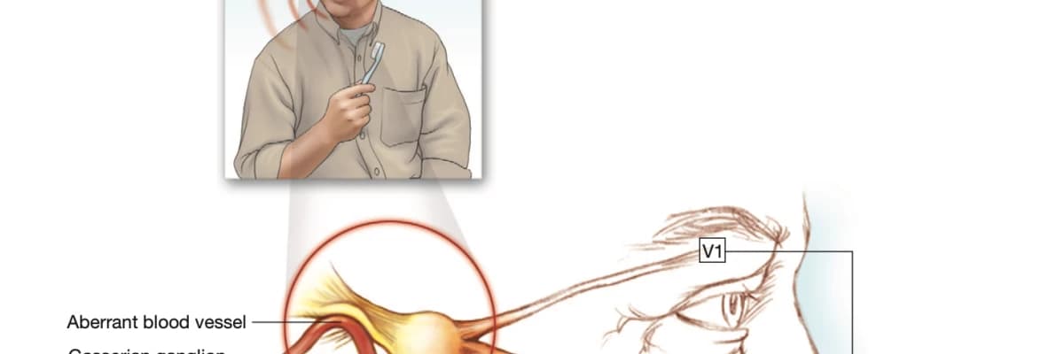 Yüz Ağrısı-Trigeminal Nevralji