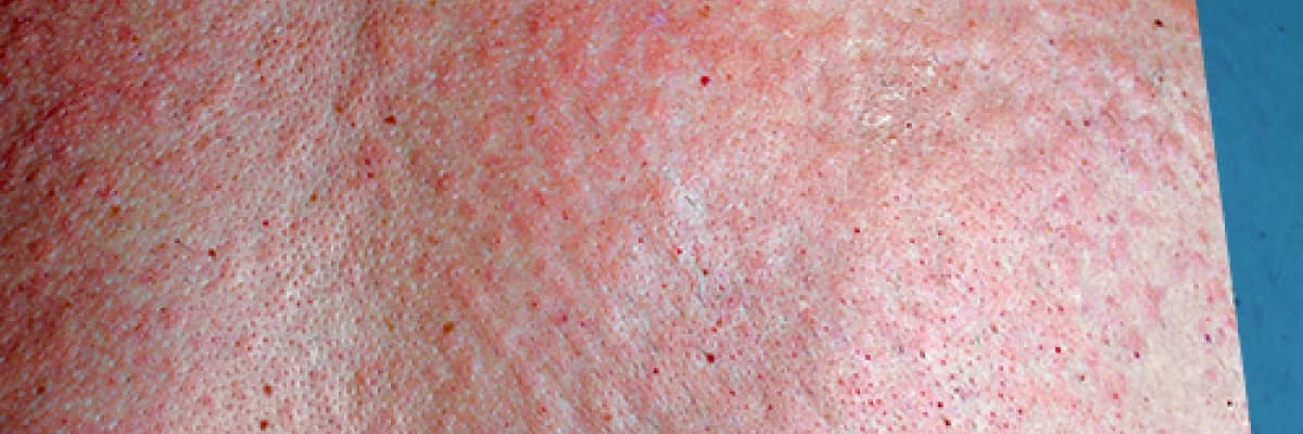 Alerjik ciltlerin bakımı nasıl olmalı?