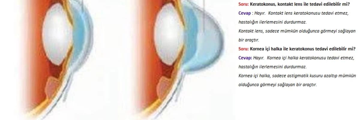 SORU VE CEVAPLARLA A’DAN Z’YE KERATOKONUS VE HİBRİD TEDAVİ