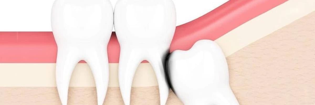 20'lik Diş Ne Zaman Çekilmelidir?