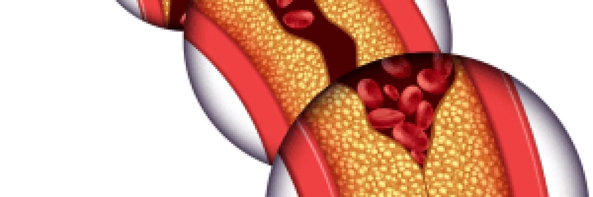 Damar Hastalıkları Risk Faktörleri