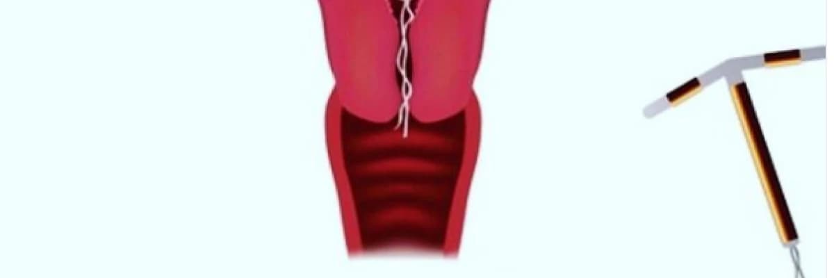 Rahim İçi Araçlar: Spiral Takılması