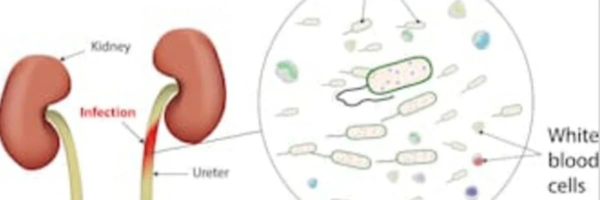 ÜRİNER SİSTEM ENFEKSİYONLARI