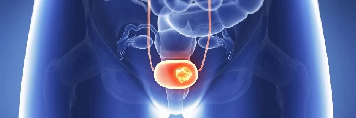 ERKEKLERDE MESANE KANSERİ