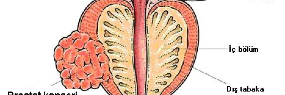 Prostat kanseri hakkında bilgilendirme