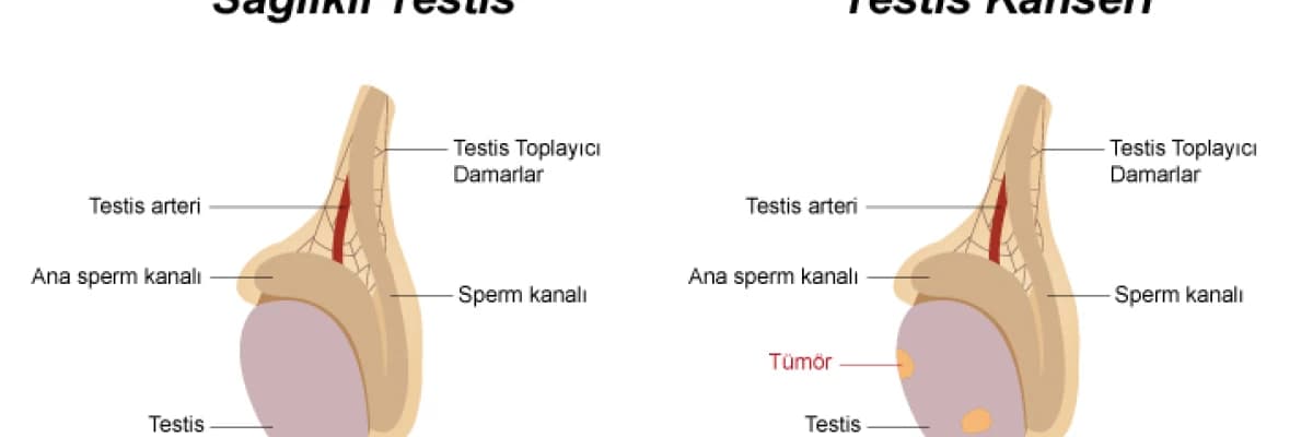 Testis Kanseri Hakkında Bilgilendirme