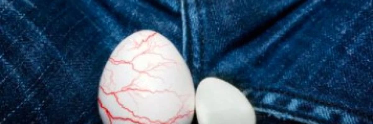 VARİKOSEL NEDİR? KİMLERDE GÖRÜLÜR?