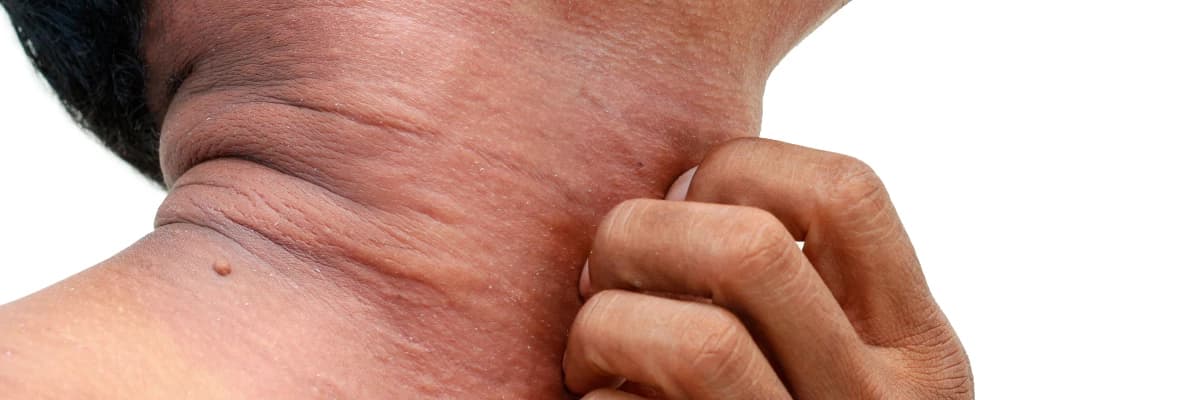 Atopik dermatit (atopik ekzema)