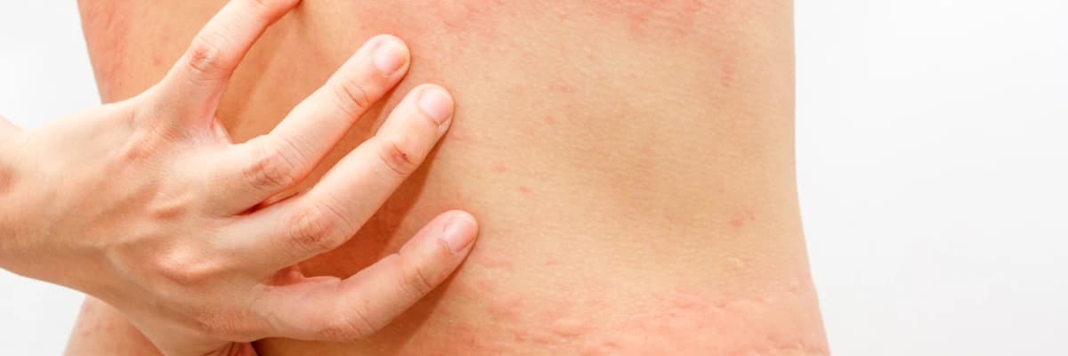 Kurdeşen (ürtiker)