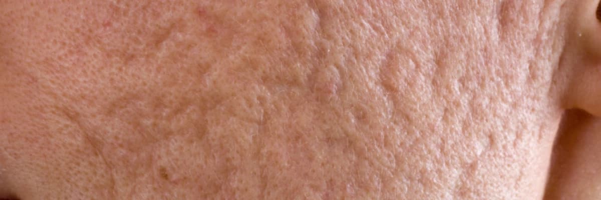 Akne izleri ve tedavi yöntemleri