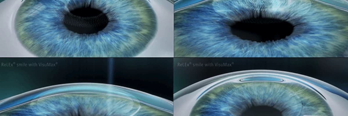Relex smile, 3. Kuşak laser cerrahisi