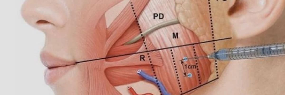 Masseter kasına Botoks