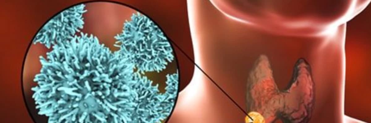 Tiroid Ameliyatı Sonrası Dikkat Edilmesi Gereken Konular?