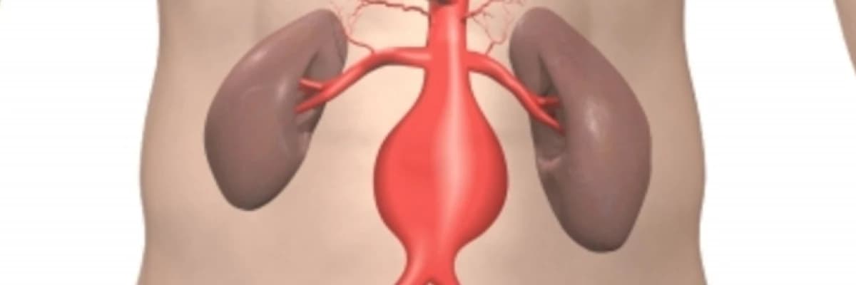 AORT DAMARI GENİŞ OLANLARIN UYMASI GEREKEN KURALLAR