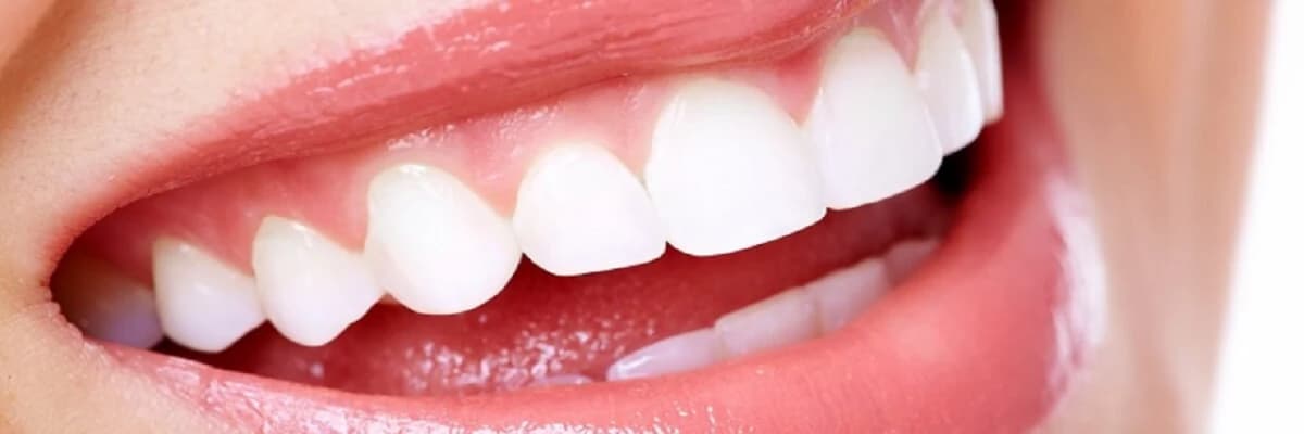 Güzel Gülüşlerin Sırrı: Diş Beyazlatma