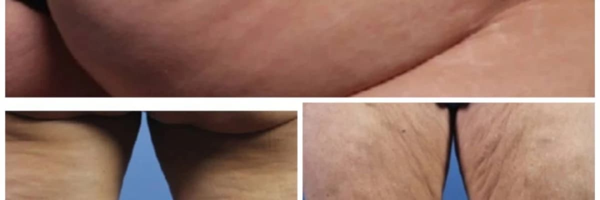 ÖNEMLİ ESTETİK BİR PROBLEM: SELÜLİT