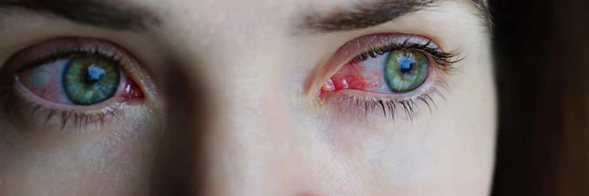 VAKA SAYILARI GİTTİKÇE ARTIYOR! GÖZLERDEKİ YENİ SALGININ KAYNAĞI: ADENOVİRÜS