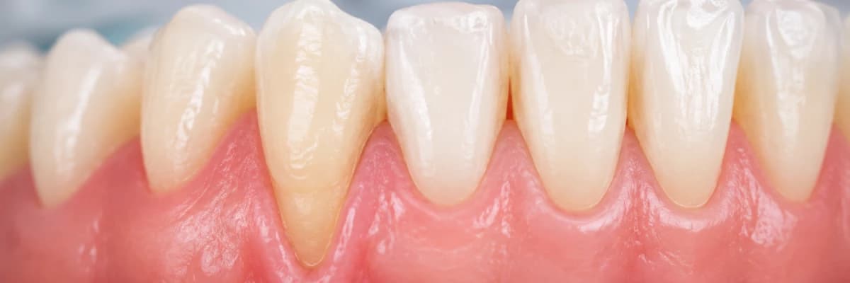 Diş Eti Çekilmesi Nedir? Neden Oluşur ve Nasıl Tedavi Edilir?