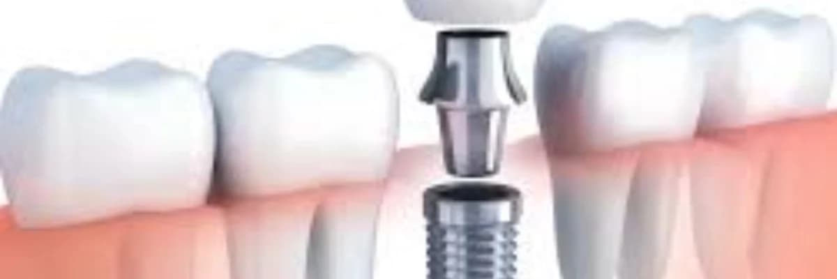 DENTAL İMPLANT