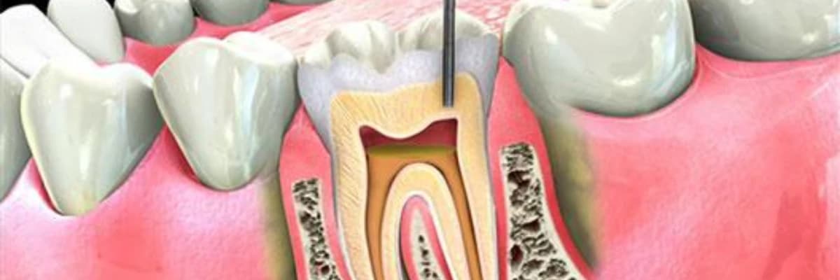 Kanal Tedavisi Nedir?