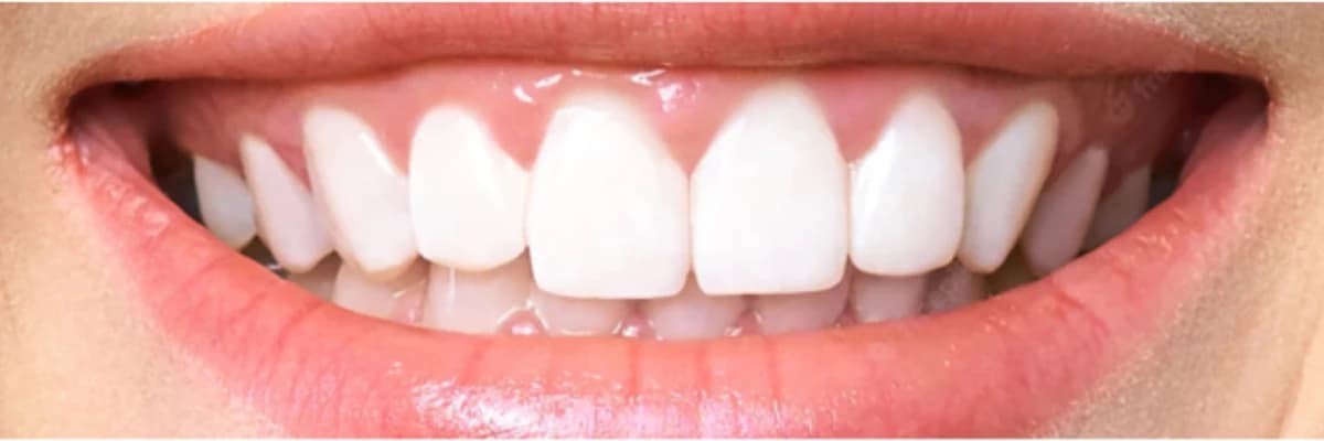 Zirkonyum Diş Kaplama