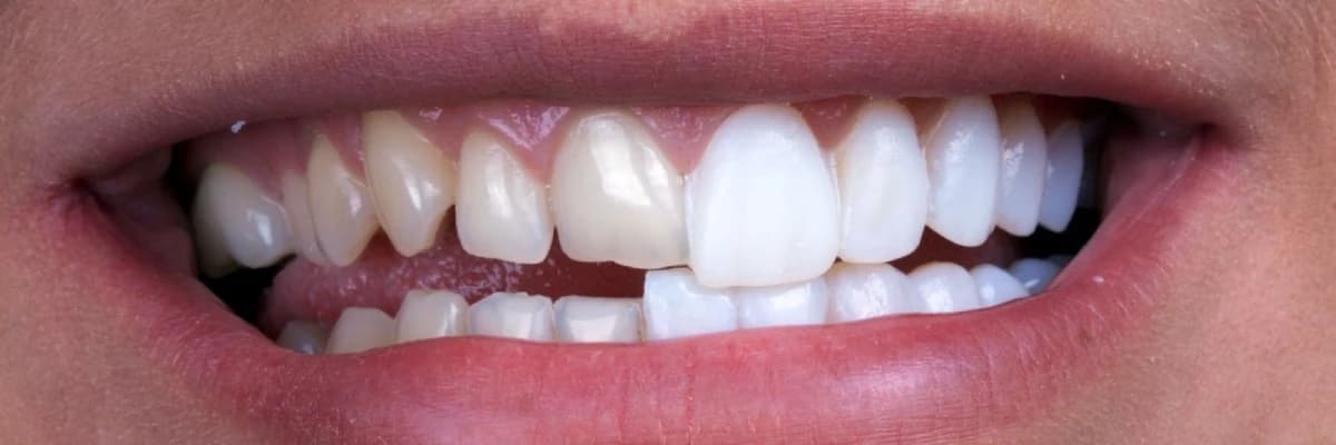 LAMİNA (YAPRAK DİŞ)