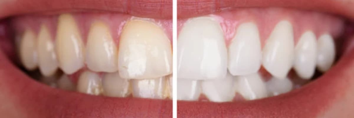 DİŞ BEYAZLATMA (BLEACHİNG)