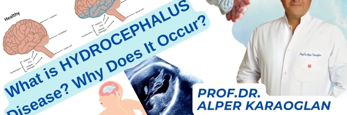 What is HYDROCEPHALUS Disease? Why Does It Occur?
