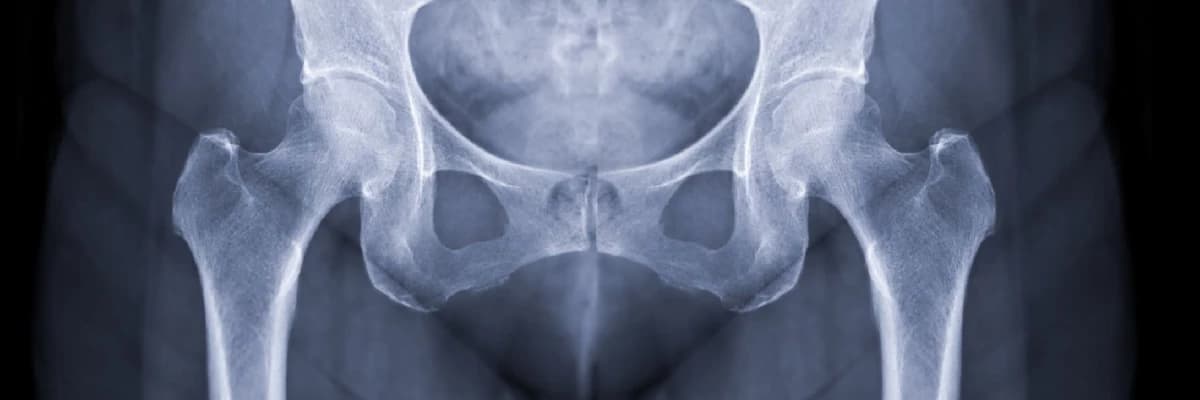 Kalça Eklemi Osteoartrit ( Kireçlenme)