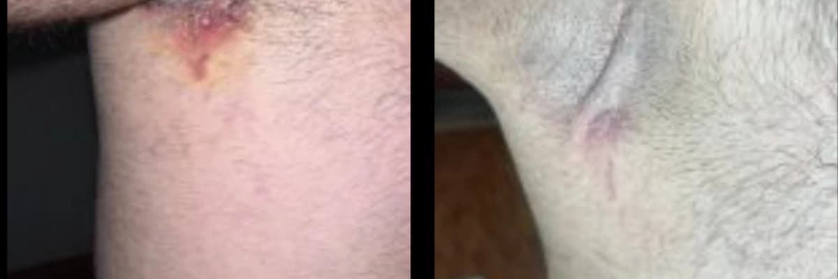 Hidradenitis Suppurativa - Köpek Memesi Hastalığı