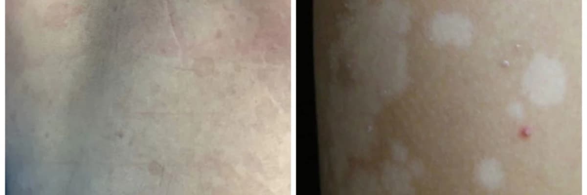 PİTRİAZİS(TİNEA) VERSİKOLOR