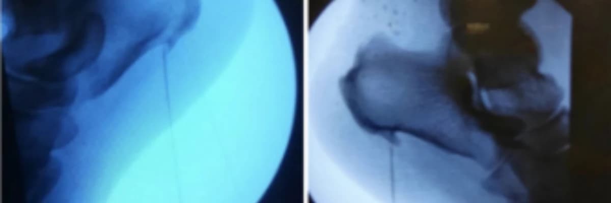 CLINICAL AND FUNCTIONAL OUTCOMES OF RADIOFREQUENCY ABLATION THERAPY IN PATIENTS WITH PLANTAR FASCIITIS