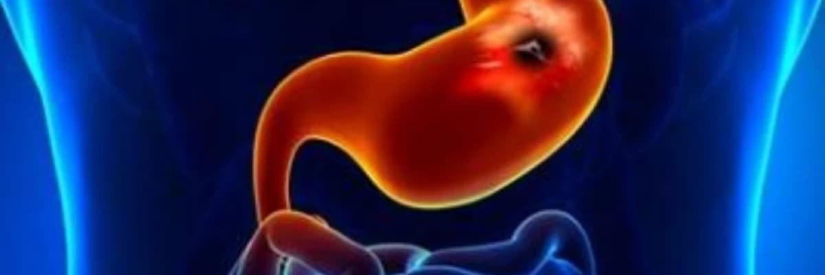 Peptik ülser nedir ?