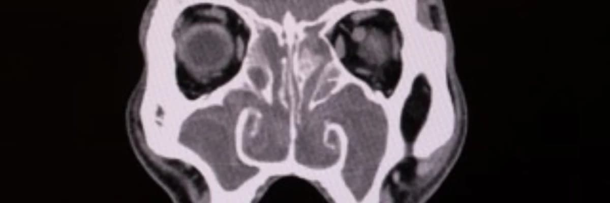 Geçmeyen Burun Tıkanıklığı: Basit Bir Grip mi, Yoksa Kronik Sinüzit mi?