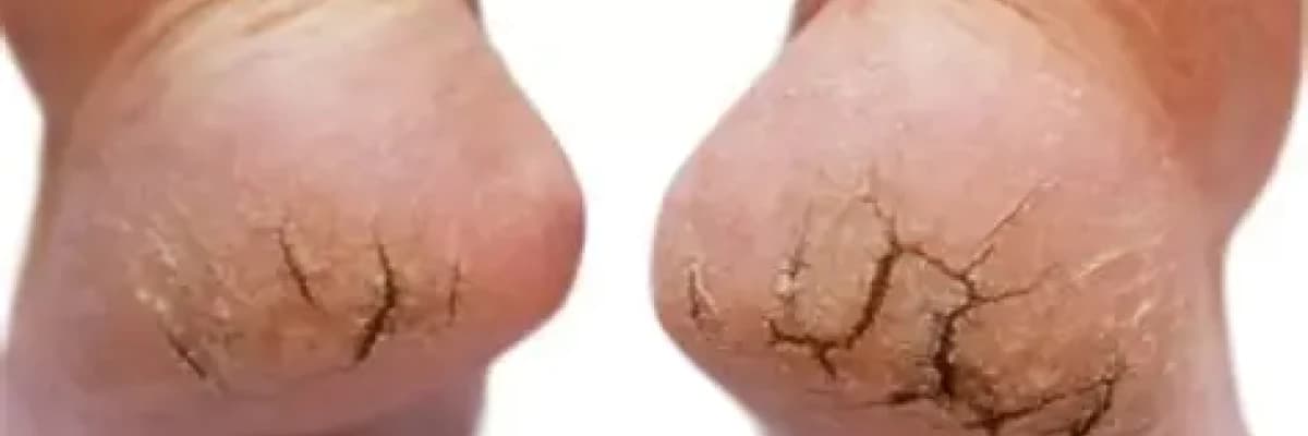 Topuk Çatlakları Neden Olur? 👣😳 Bir Türlü Geçmeyen Çatlakların Sebebi Ne?