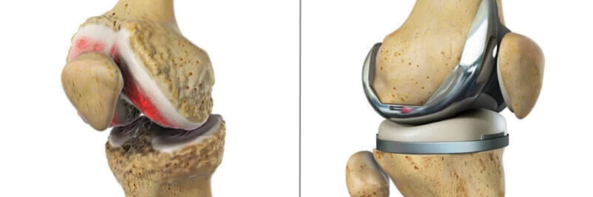 TOTAL DİZ ARTROPLASTİSİ SONRASI FİZYOTERAOPİ İŞLEVSELLİK VE DENGE