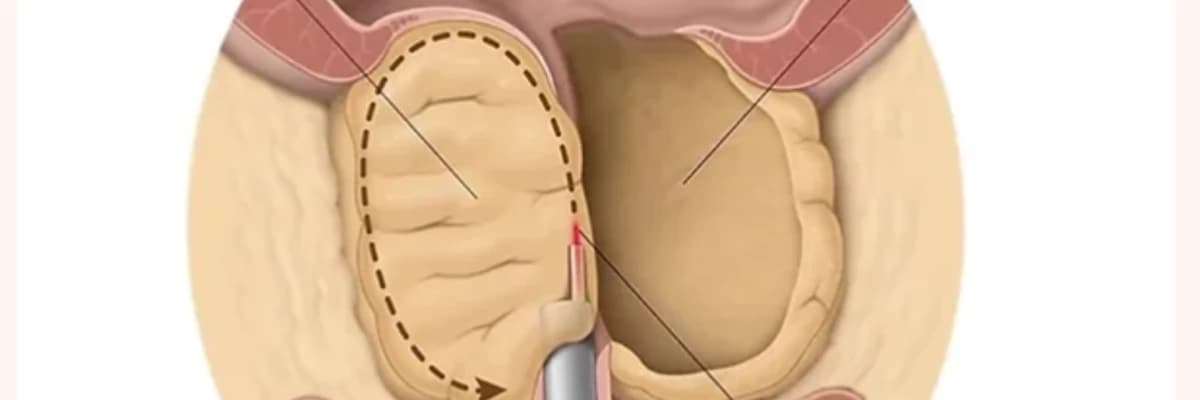 LAZERLE PROSTAT AMELİYATI