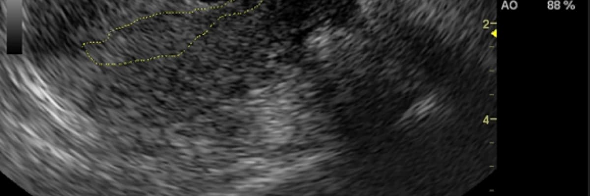 sezaryen Skar Gebelikleri