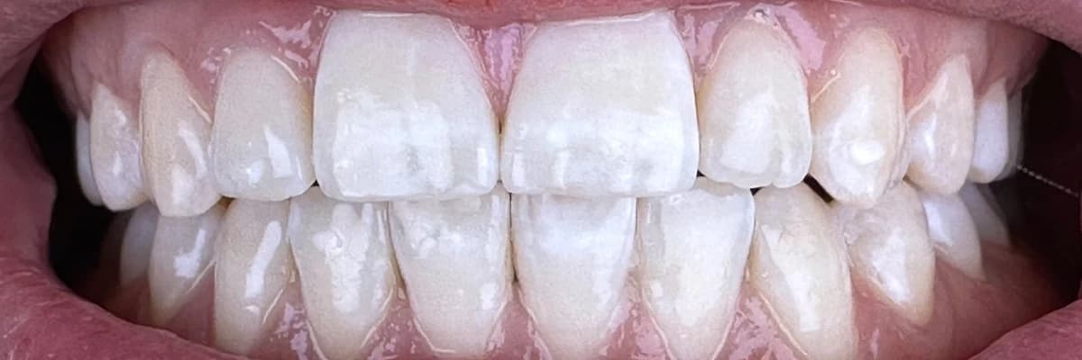 Gülüş Tasarımı: Sağlıklı ve Estetik Gülümsemelerin Sırrı