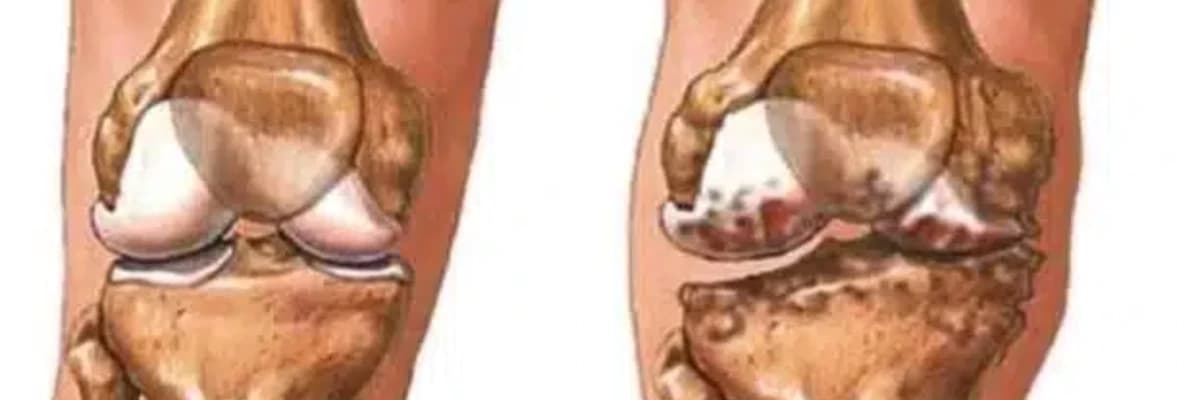 Diz Kireçlenmesi – Gonartroz(Osteoartrit)