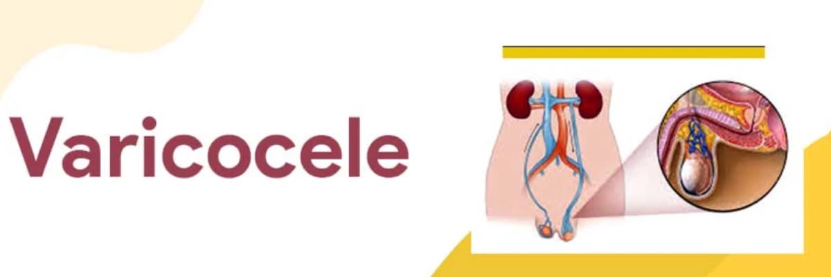 Varikosel: Sessizce İlerleyen ve Erkek Fertilitesini Tehdit Eden Damar Sorunu