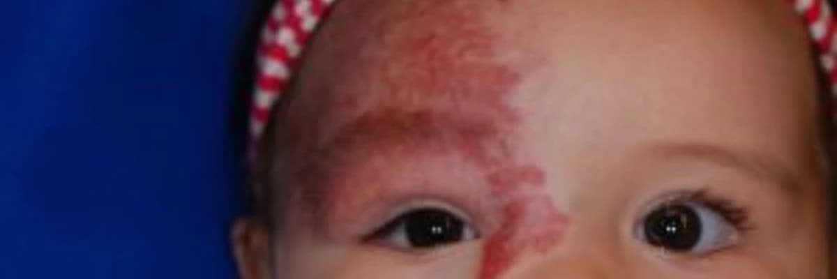 Hemanjiomun vücutta görüldüğü bölgeler