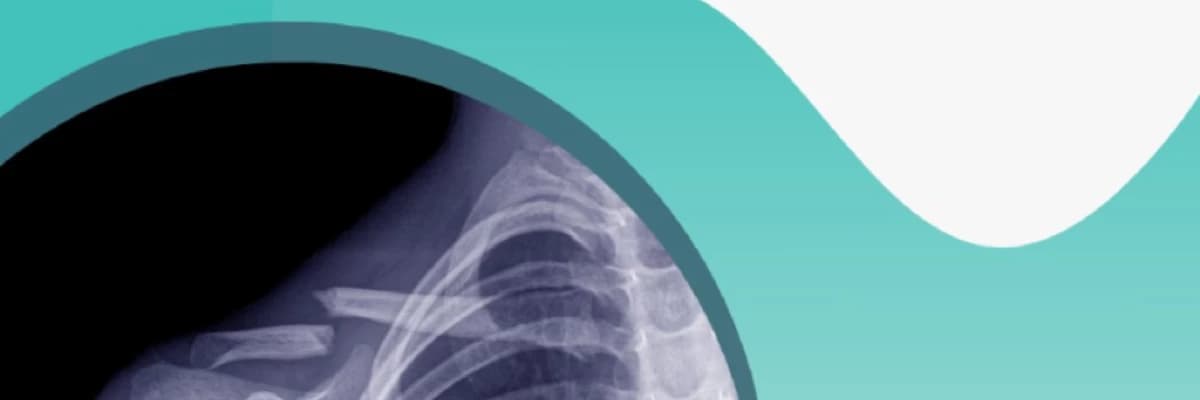 Klavikül Kırığı