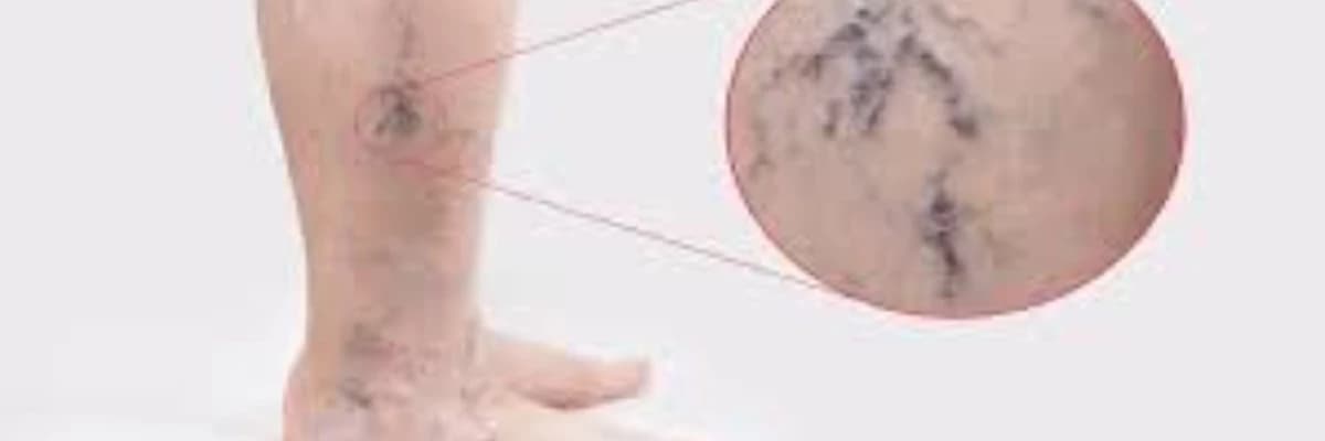 Huzursuz bacak sendromunda tek nedeni varis midir?