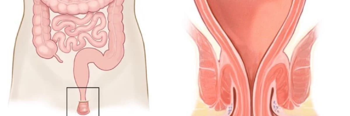 Rektal prolapsus (Makat sarkması)