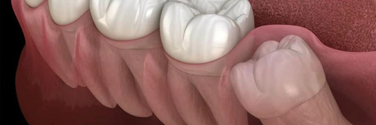 Gömülü 20 yaş dişleri neden çekilmeli midir?